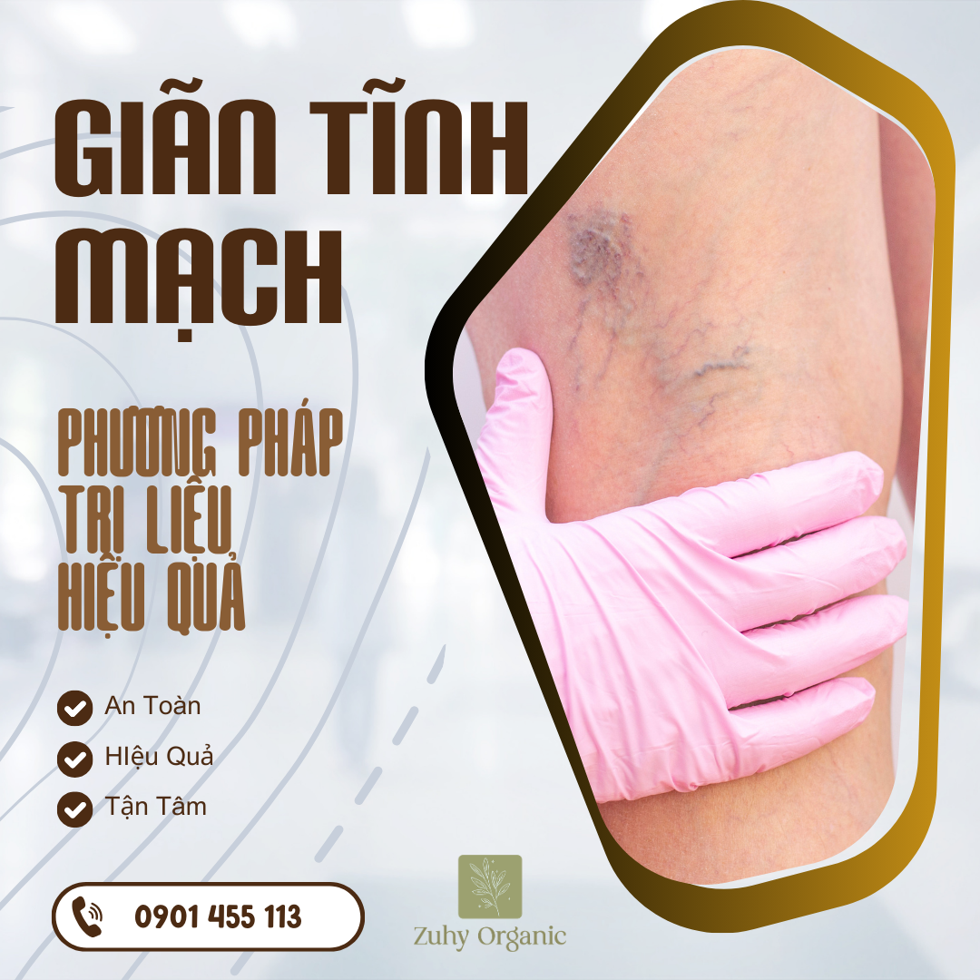 điều trị giãn tĩnh mạch