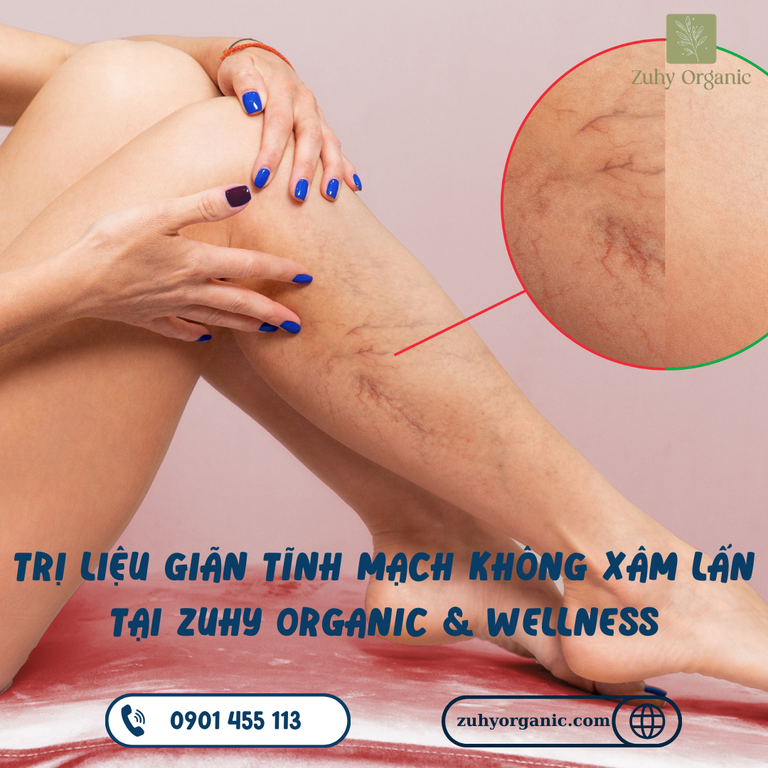 điều trị giãn tĩnh mạch không xâm lấn