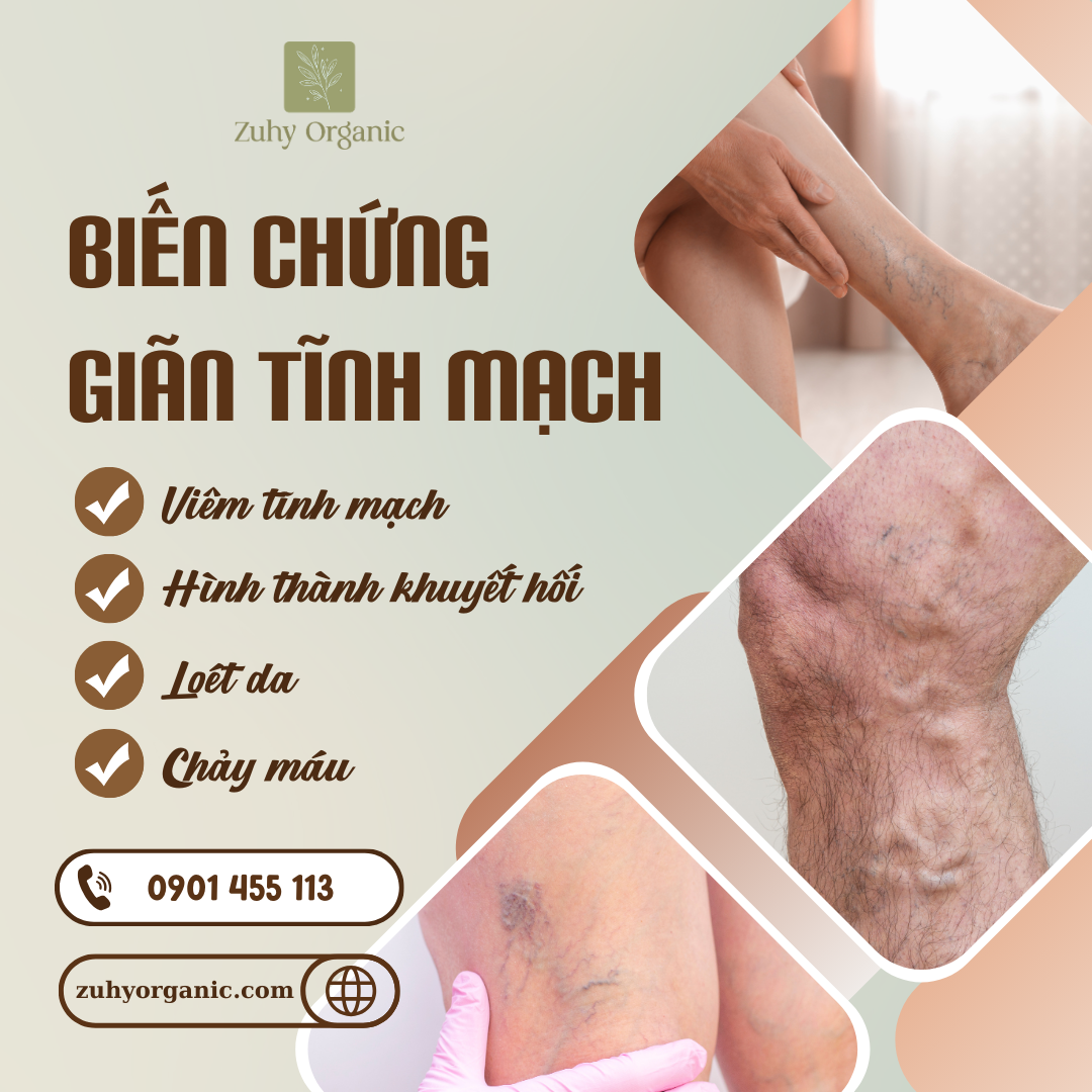 Biến chứng giãn tĩnh mạch
